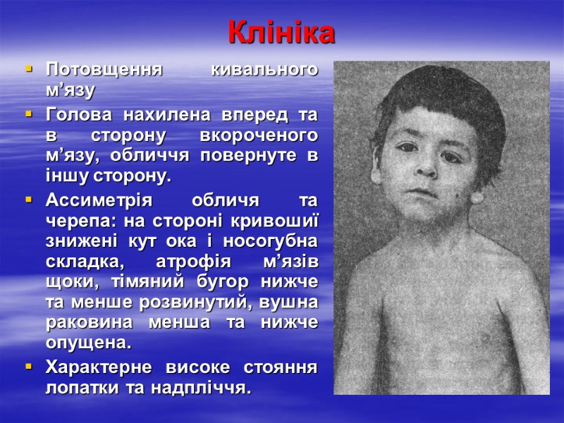 Клініка Потовщення кивального м’язу Голова нахилена вперед та в сторону вкороченого м’язу, обличчя повернуте